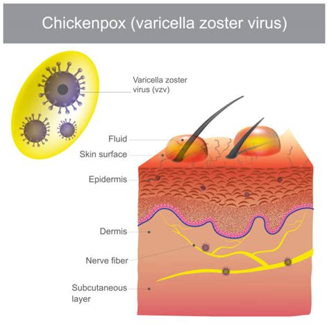 990 Virus Del Herpes Zoster Ilustraciones De Stock Gráficos