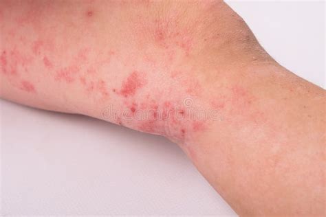 Rash On A Child Leg On White Background Redness Allergic Reaction