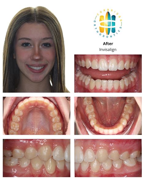 Before And After Orthodontic Treatment Corbridge Orthodontics