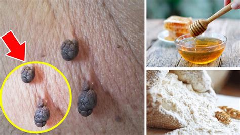skin tag removal at home quick fast [natural remedy] skin tag removal easy way youtube