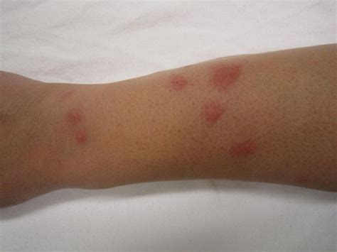 Bed Bug Rash On Arm Pest Phobia