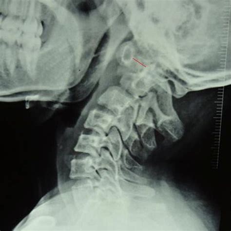 Radiogram Lateral View Of Cervical Spine Showing Atlantoaxial