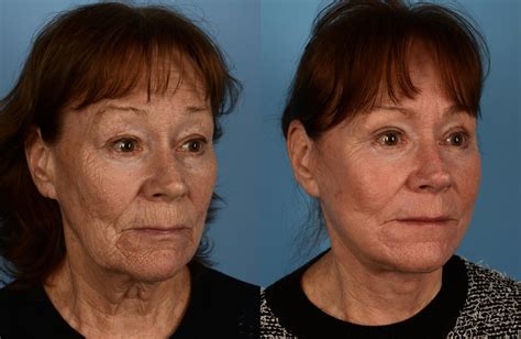 facelift neck lift before and after pictures case 197 toronto on ford plastic surgery dr
