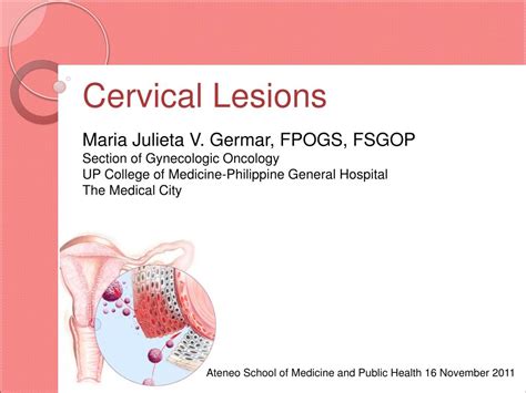 PPT Cervical Lesions PowerPoint Presentation Free Download ID