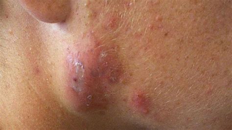 Cystic Acne Identification Causes And More