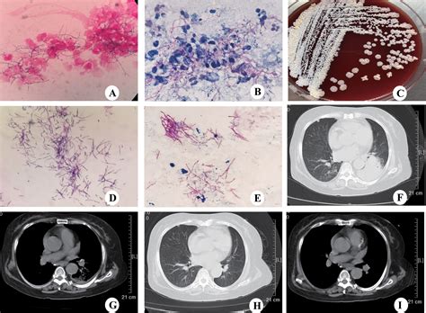 Frontiers Nocardia Infection In Nephrotic Syndrome Patients Three