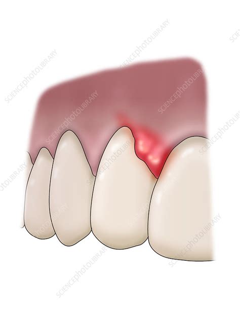 Periodontal Abscess Illustration Stock Image C0366280 Science