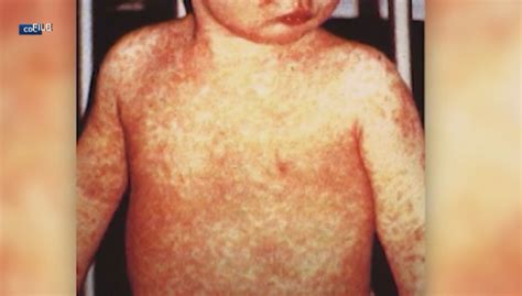 Are You Protected From The Measles It May Depend When You