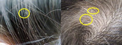 What Do Head Lice Nits Look Like
