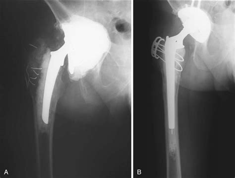 Cemented Femoral Revision In Total Hip Arthroplasty A View In The 21st