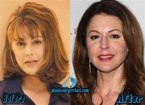 Jane Leeves Plastic Surgery Before And After