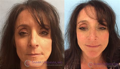 Juvederm For Nasolabial Folds And Marionette Lines Botox Fillers