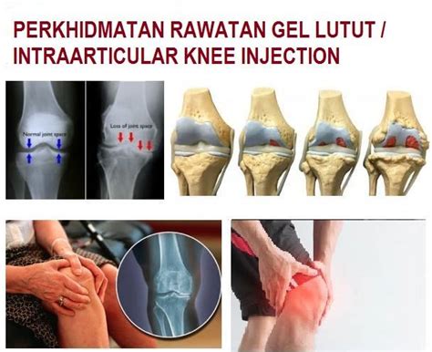 Wangsa maju is one of the largest townships in kuala lumpur and consists of many sections — section 1, 2, 4, 5, 6 and 10. Rawatan Osteoarthritis | Klinik Dr Alyna