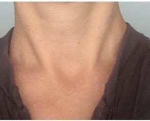 Post Operative Incisions Scars Gallery Austin Thyroid Surgeons