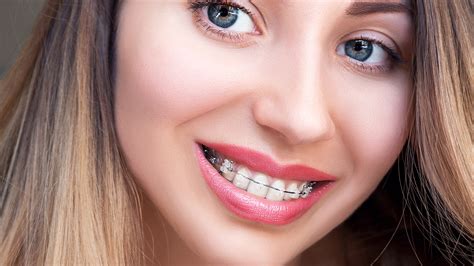Fort Worth Orthodontist Offers Braces That Blend With Your Smile | Fort ...