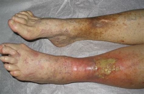 Prevention tools pressure ulcer prediction, prevention and treatment pathway: Venous Stasis Ulcer - Treatment, Pictures, Causes, Symptoms