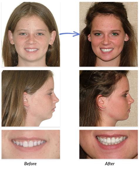 Before After Braces Photos Delurgio Orthodontics Delurgio