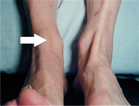 Tibialis Anterior Tendon Foot