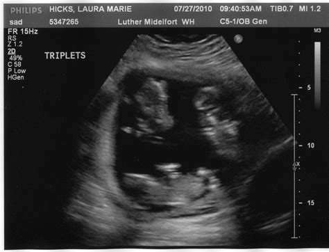 Hicks Triplets Ultrasound Pics