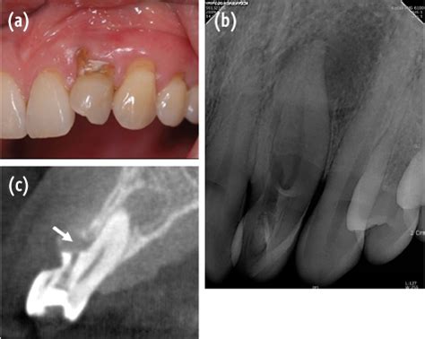 Endodontic Management Of A Maxillary Lateral Incisor With Dens