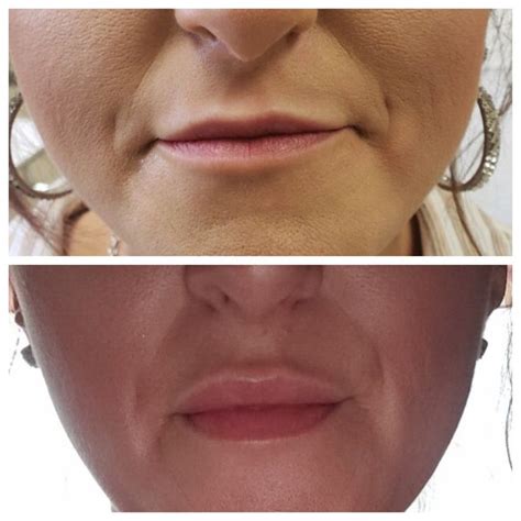 Botox Lip Flip Botox Lips Botox Aesthetic Dermatology