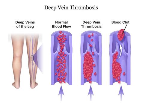 A Closer Look At Deep Vein Thrombosis