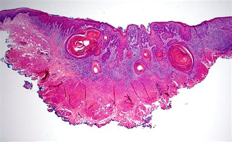 Infiltrative Keratinizing Squamous Cell Carcinoma Download