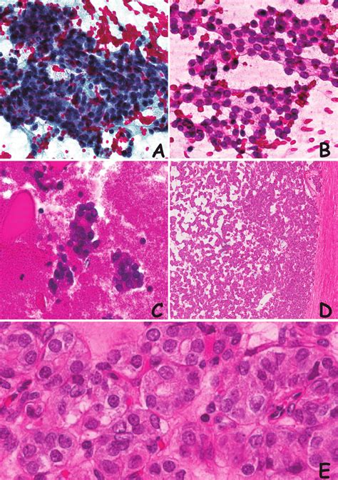 Cytological And Histological Appearance Of A 25 Mm Thyroid Nodule In