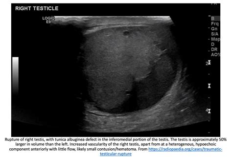 EmDOCs Net Emergency Medicine EducationEM 3AM Testicular Rupture