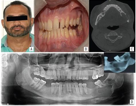 Scielo Brasil Glandular Odontogenic Cyst Report Of An Unusual Case