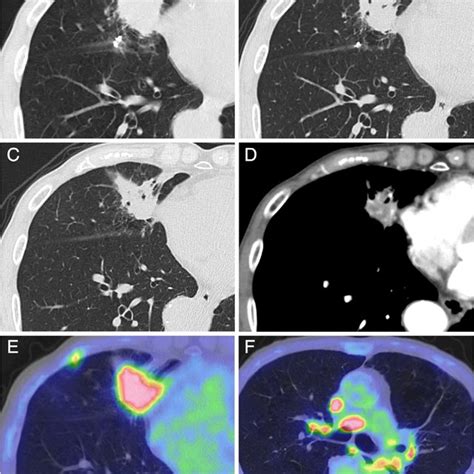 A Chest Computed Tomography Ct Scanning Reveals A Mass In The Right