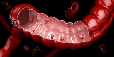 Your Guide To Making Polyp Removal Decisions American