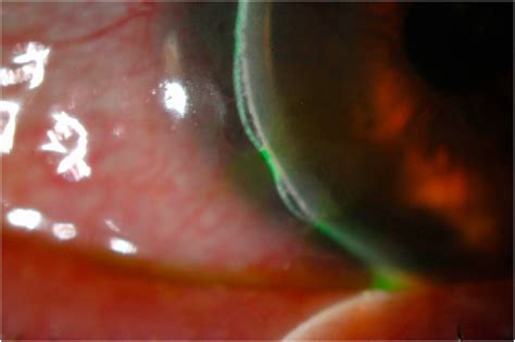 Transient Corneal Epithelial Bullae Associated With Large Diameter