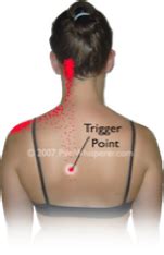 The exact cause is not known. Pin on Trigger Points
