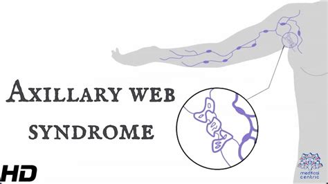Everything You Need To Know About Axillary Web Syndrome Healthytimes