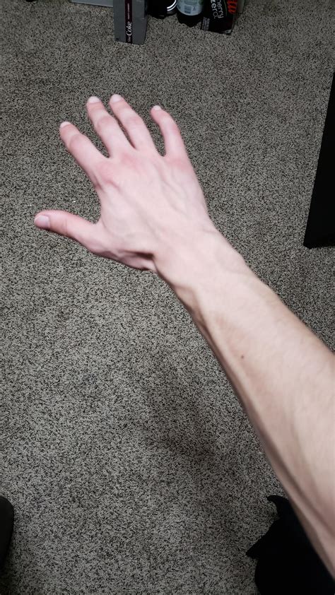 Can Anyone Explain Why My Arms Get Super Veiny After A Binge R