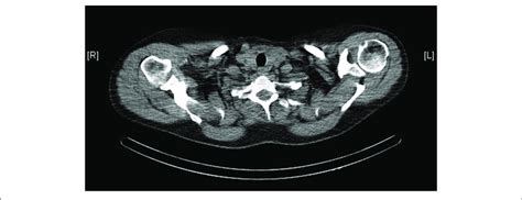 Ct Scan Of The Neck Showing A Normal Thyroid Gland Download