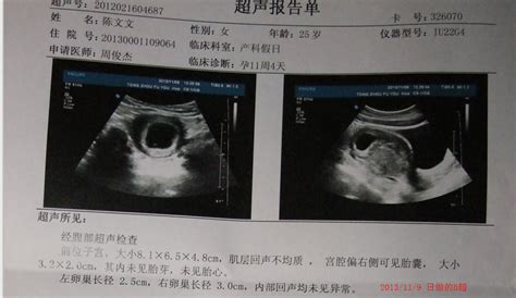 怀孕了大约10周左右应为我月经40多天来一次，有点月经不调 今天拍b超说看不到胎芽和胎心麻烦懂 百度宝宝知道