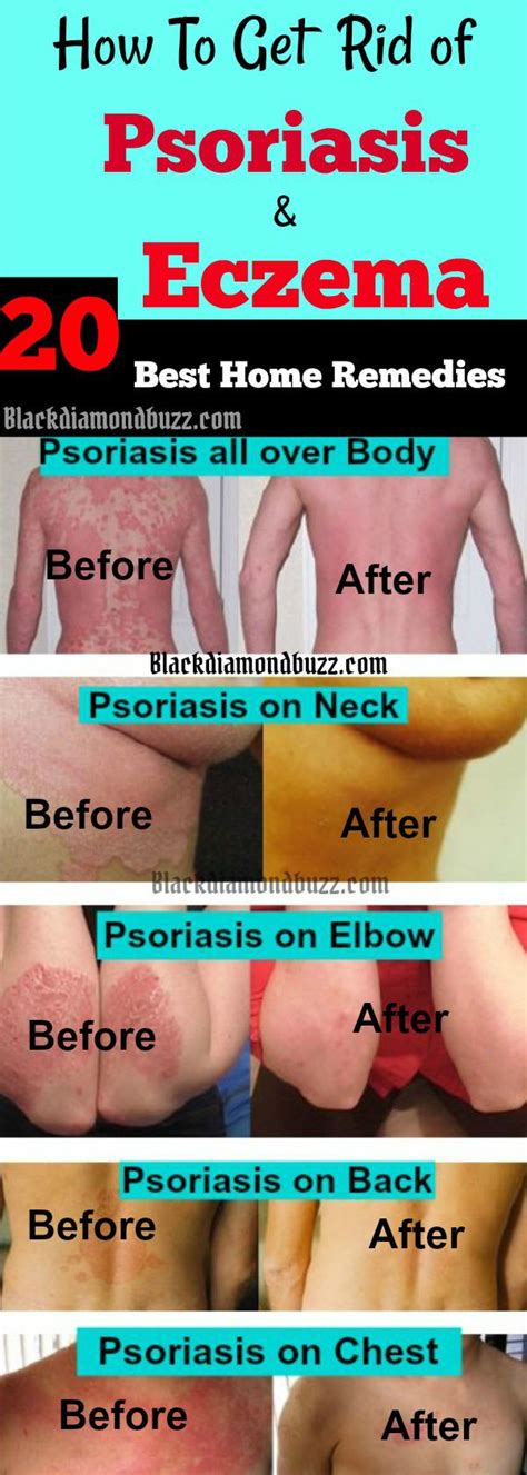 20 Home Remedies For Psoriasis And Eczema That Work