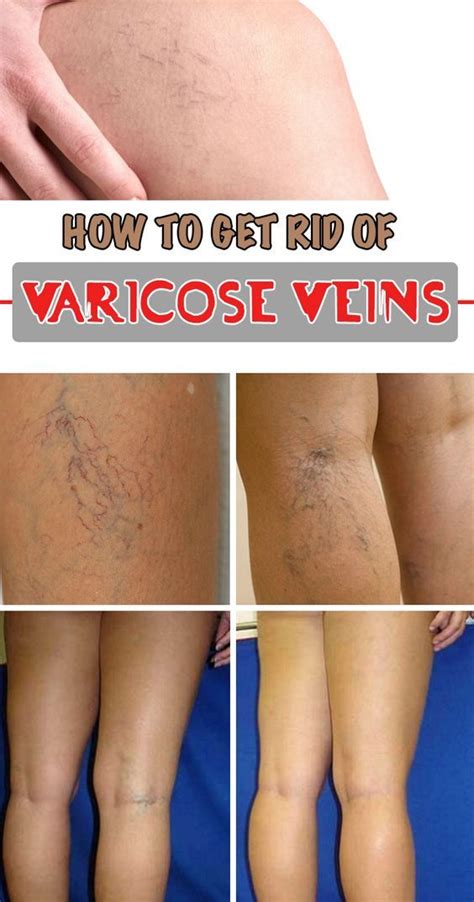 How To Get Rid Of Varicose Veins Varicose Veins Treatment Varicose