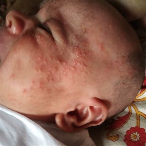 My Baby Is Having Some Spots Of Allergy Type On Bodylooks Like Fungal