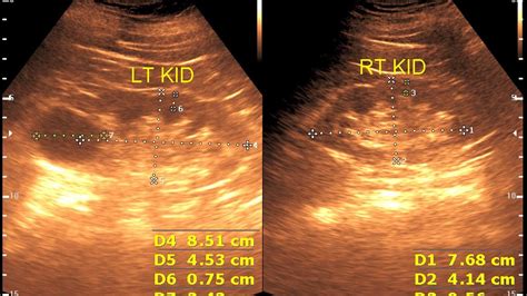 Ultrasound Cases 183 Of 2000 Ckd Renal Cortical Cyst Pancreatic