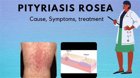 Pityriasis Rosea Causes Symptoms Treatment Neetpg Quick