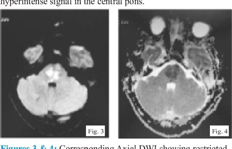 Figure From Early Detection Of Central Pontine Myelinolysis With Mri