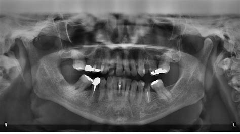 Reamer Family Dentistry Blog Why Do We Take Dental X Rays