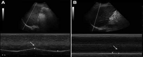 Diaphragm Dysfunction Assessed By Ultrasonography Influence