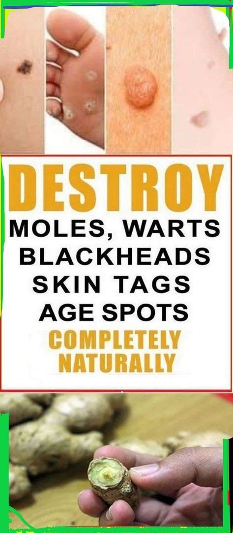 Natural Cure For Moles Warts Skin Tags Age Spots And Blackheads In