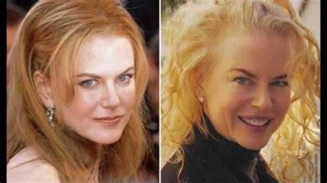 Nicole Kidman Botox Disaster Plastic Surgery Face Lift Surgery