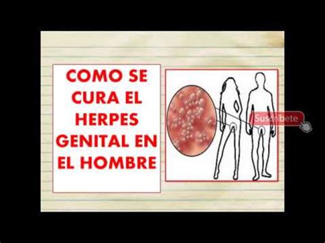 Como Se Cura El Herpes Genital En El Hombre O Mujer Se Puede Curar