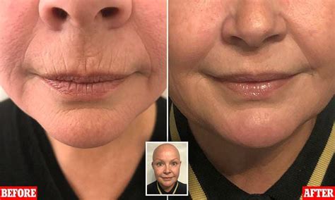 Botox Before And After Lip Lines Before And After